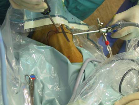 chirurgia-cartilagini-artroscopia